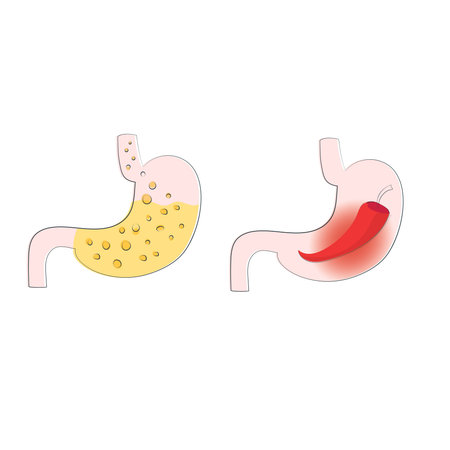 Visualization of stomach heartburn, gastritis and acid reflux, ulcers.  Strong burning sensation and a full stomach of hydrochloric acid. Vector illustration of a disease of the stomachのイラスト素材