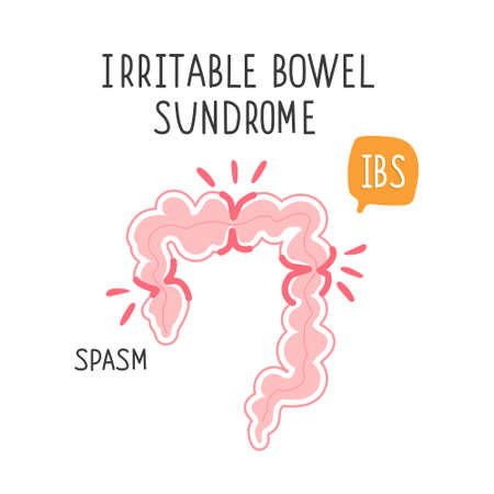 Irritable bowel syndrome. Illustration of a spasm on the gut. Vector illustration of medical posters in gastroenterologyのイラスト素材
