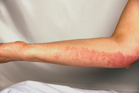 Strong allergic rashes on the arm. Impaired immunity and reaction to allergenic products. Dermatological rash on the skin and body. cosmetic problemの写真素材