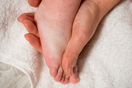Legs of little child with red rash, closeup. Concept of babies allergies.の写真素材