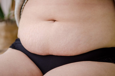 Belly of a young European woman after pregnancy and childbirth. Stretch marks and excess fat. Woman...