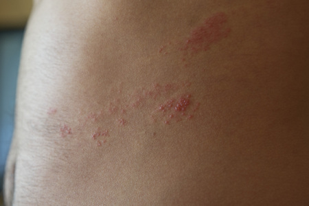 close up on zoster disease on human skinの写真素材