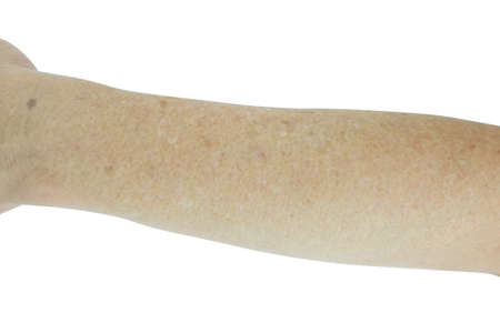 Small white and brown spots on the skin of senior man arm (Idiopathic guttate hypomelanosis).  Isolated on white background.の写真素材