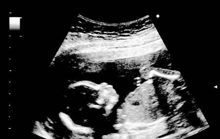 An ultrasound of a human fetus during the 18 week.の写真素材