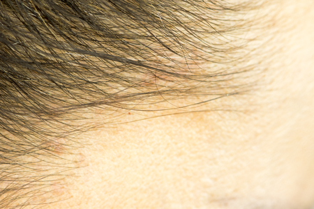 the hairline and on the scalp close up, dermatological diseases, skin problemsの写真素材