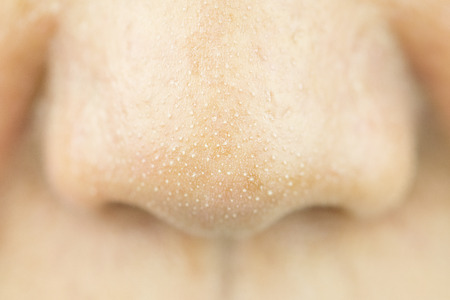 Close Up acne small pimple on nose. concept of beauty and health.の写真素材