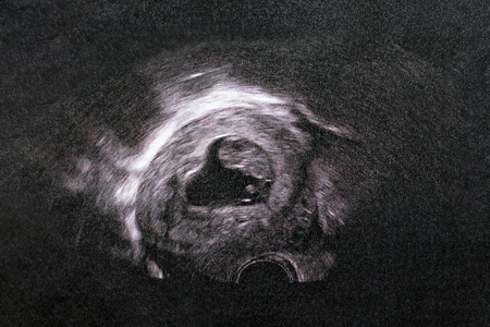 Picture of Ultrasound of baby in mother's womb.の写真素材