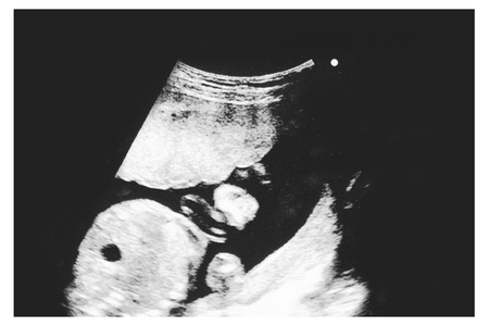 picture of Ultrasound of baby in mother's womb. 21 week.の写真素材