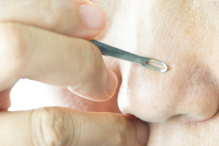 comedone extractor to acne small pimple on nose. concept of beauty and health.の写真素材