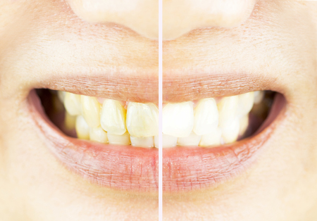 before and after bleaching. Dental care and whitening teethの写真素材