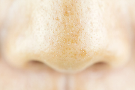 Close Up acne small pimple on nose. concept of beauty and health.の写真素材