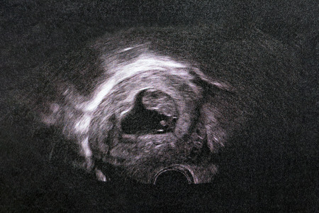 Picture of Ultrasound of baby in mother's womb.の写真素材