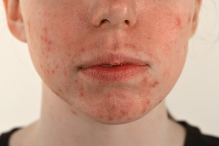post-acne, scars and red festering pimples on the face of a young woman. concept of skin problems and harmonic failure - imageの写真素材