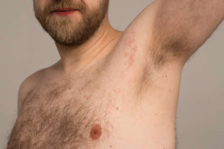 Allergy reaction is red spots on the body of a young man. Urticariaの写真素材