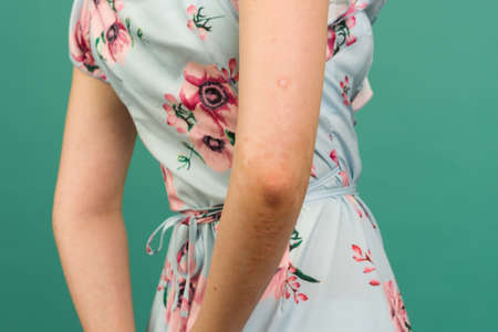 CLOSE UP: Unrecognizable young woman suffering from autoimmune incurable dermatological skin disease called psoriasis. Red, inflamed, scaly rash on elbows. Psoriatic arthritisの写真素材