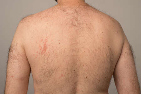 Allergy reaction is red spots on the body of a young man. Urticaria