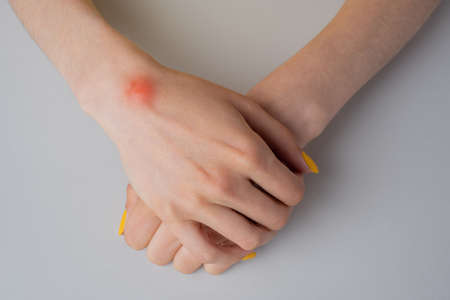Ganglion cyst on woman hand on white backgroundの写真素材
