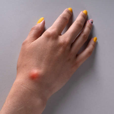Ganglion cyst on woman hand on white backgroundの写真素材