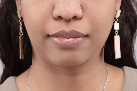 close up of chapped young woman, cracked lips caused wound on corner of lips without makeup, Part of...