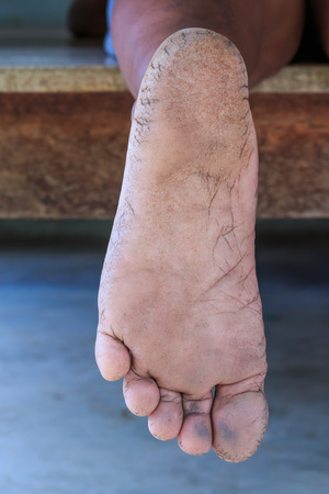 Closeup view of Cracks on a Heel の写真素材