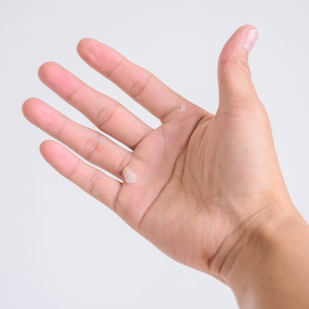 Hand blister from working hard.の写真素材