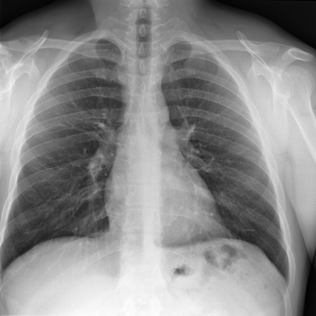 X-ray of chest.