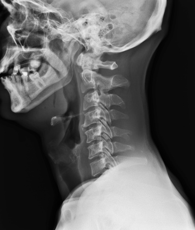 X-ray of neck.の写真素材