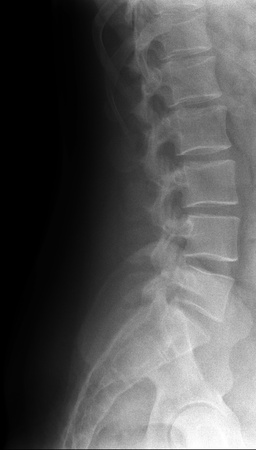 Lumbar spine. X-ray medical photo.