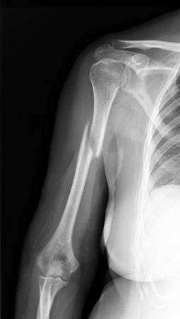 Broken arm - X-ray of humerusの写真素材