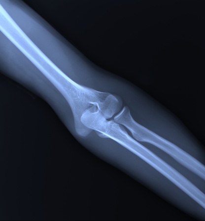 X-ray of the elbow joint. blue.の写真素材