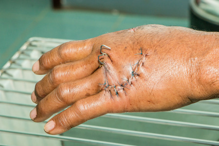 suture of woundの写真素材