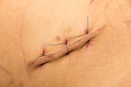 suture of woundの写真素材