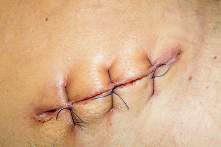 scar from operation suture with a blue fiberの写真素材