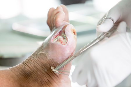 infected wound of diabetic footの写真素材
