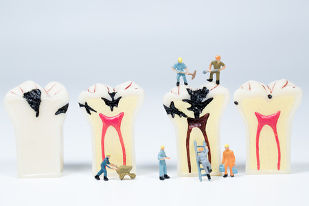 miniature people clean tooth model,medical conceptの写真素材