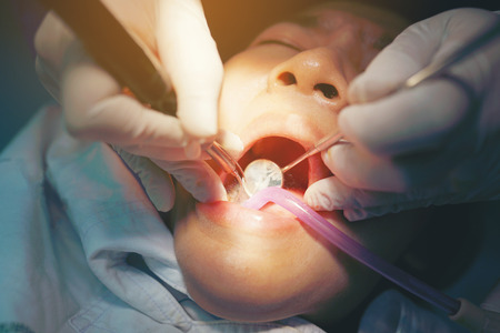 close up dentist use tool filling carious tooth in dental clinic