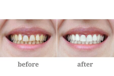 Teeth close-up after dental therapy and whitening. Before and after.