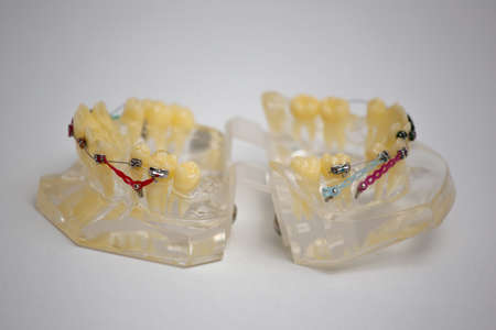 Dental examinations, dental cleaning systems, with braces, shows the dentist