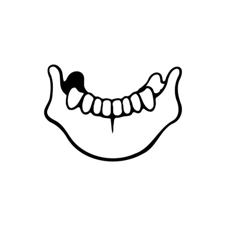 A black and white vector graphic depicts a lower jaw bone with teeth, one of which has a cavityのイラスト素材