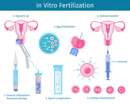 In Vitro Fertilization Process Conceptのイラスト素材