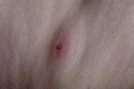 Castor bean tick (Ixodes ricinus)