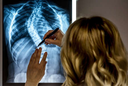 Blonde female physician looking at a patients x-ray. Scoliosis specialist Doctor making measurements...