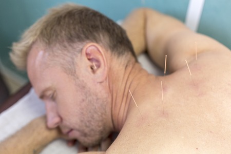 Young man getting well with his neck acupuncture treatment, closeupの写真素材