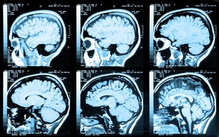 Health medical image of an MRI / MRA (Magnetic Resonance Angiogram)  of the head showing the brain