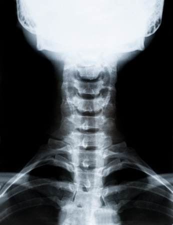 X-ray image of neck cervical spine isolated on black backgroundの写真素材