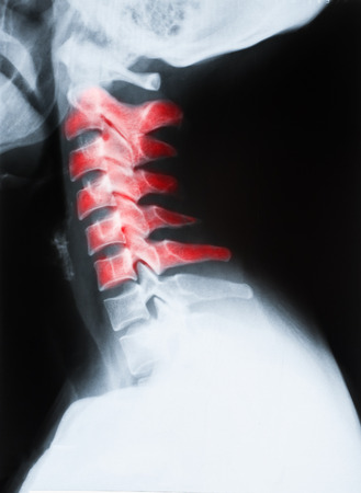 X-ray image of neck cervical spine isolated on black backgroundの写真素材