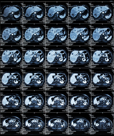 MRI scan of the Human Abdomen organsの写真素材