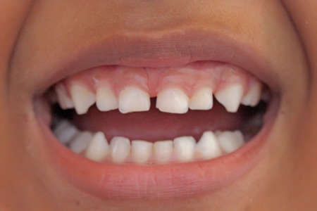 Rows of teeth for children under five years old.