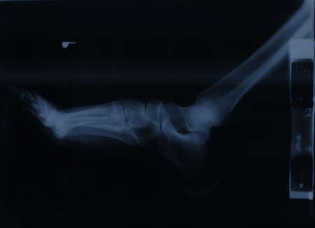 X-ray of a ankle joint の写真素材