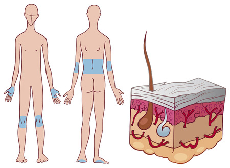 skin psoriasis diseaseのイラスト素材